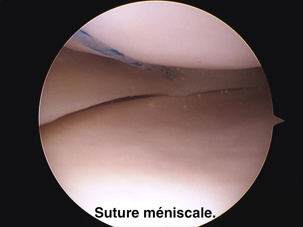 suture en attendant (path&trait)